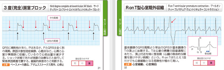 救急隊員 救急救命士向け講座 心電図モニターと12誘導心電図の違いを解説 消防士 救急隊員の日常